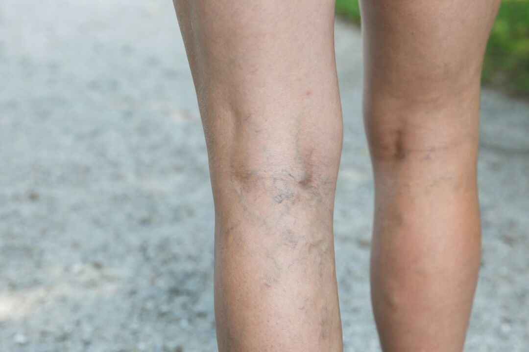 In the case of varicose veins, the exercise program should be discussed with the doctor. 